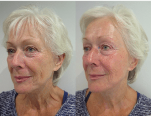 Before and after photos of left side face after S-Thetics Signature treatment, combined skin tightening and Fire & Ice facial for instant reduction of wrinkles, fine lines with glowing, hydrated skin