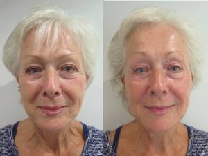 Before and after photos of full face after S-Thetics Signature treatment, combined skin tightening and Fire & Ice facial for instant reduction of wrinkles, fine lines with glowing, hydrated skin