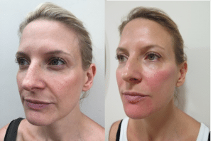 Before and after photos after dermal filler treatment with reduction of lines and subtle increase in facial volume