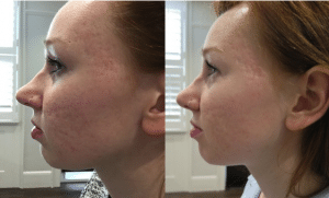 Before and after photos following a combination of iS Clinical skincare, Fire & Ice facial treatments and microneedling. After photo is taken 3 months after the initial treatment.