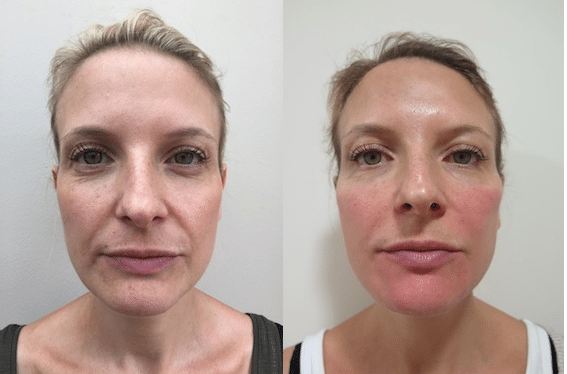 S-Thetics Beaconsfield dermal filler testimonial full face both