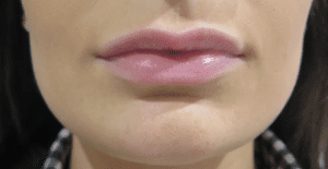 lip-fillers-buckinghamshire