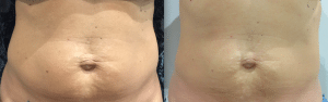 After photo shows tighter, firmer skin with reduction in circumference and cellulite