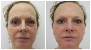 facial-fillers-treatment-with-subtle-natural-results-S-Thetics-Beaconsfield