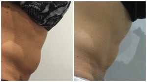 After photo taken following x6 Endymed treatments and 1st of 3 microneedling treatments