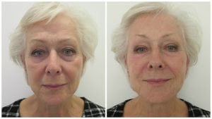 Before and immediately after dermal filler treatment with reduction of lines and improvement in skin volume, structure and texture