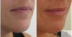 Before and after photos showing subtle increase in lip volume, hydration and definition.