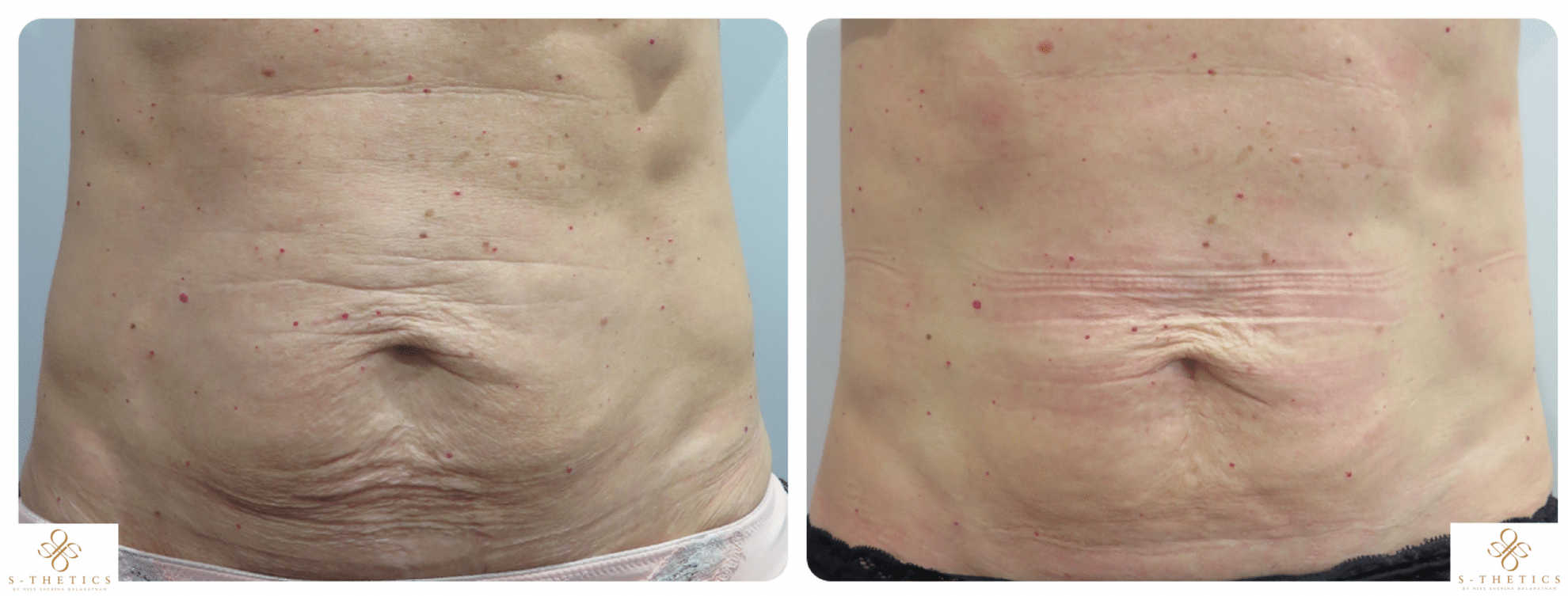 post-pregnancy-tummy-skin-tightening-at-s-thetics-clinic-beaconsfield