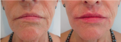 Lip enhancement – Patient Success Story