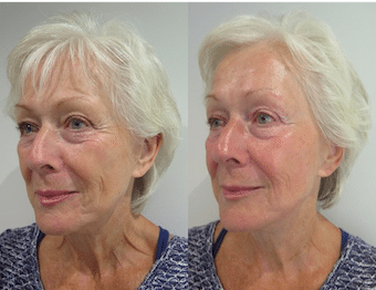 Patient Testimonial: S-Thetics Signature Treatment & before and after photos