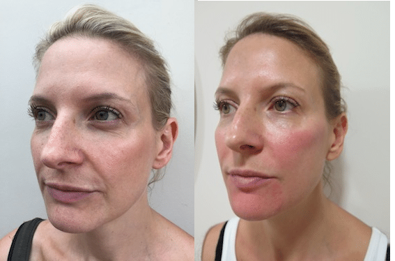 Dermal Fillers – patient experience