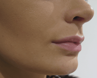 Lip Enhancement – Patient Success Story