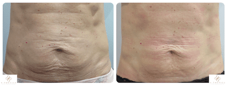 Patient Success Story – Post pregnancy tummy skin tightening