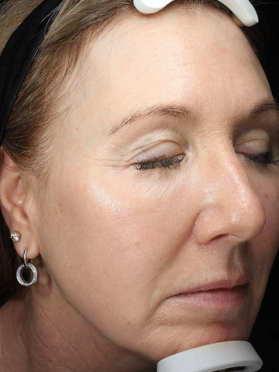 skin-conditioning-at-S-Thetics-Skin-clinic-in-Beaconsfield