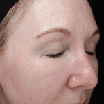 reduce-facial-redness-at-S-Thetics-Skin-Clinic