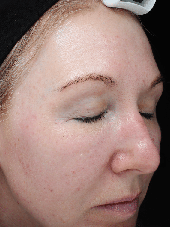 improve-skin-health-skin-clinic-beaconsfield-S-Thetics