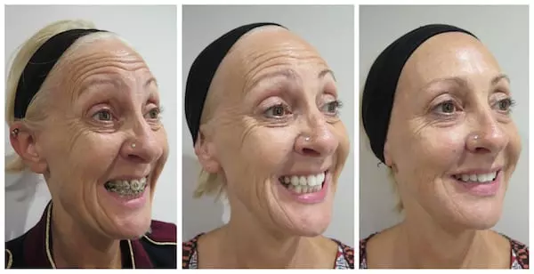 Patient Success Story – Treatment Blending at S-Thetics Clinic