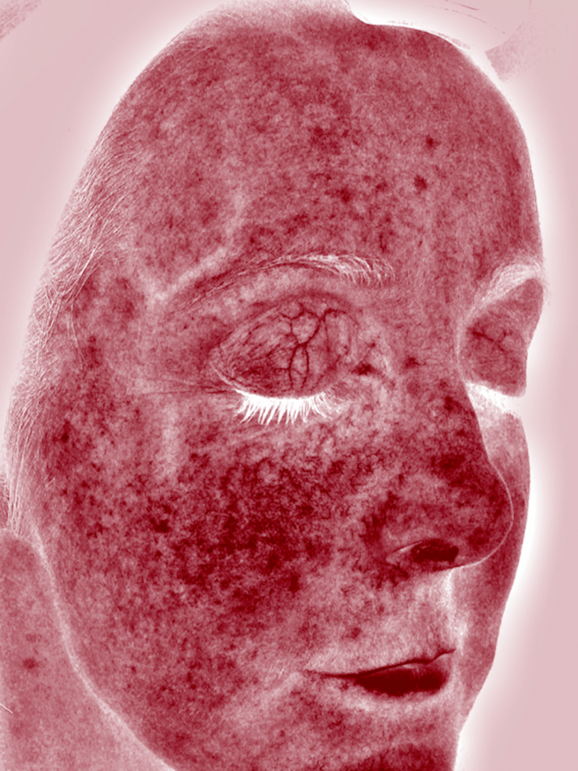 reduce-facial-redness-at-S-Thetics-Skin-Clinic