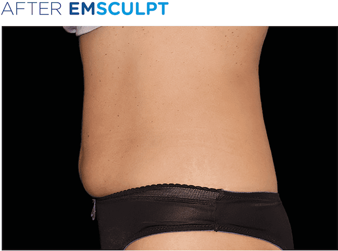 BTL-EMSculpt-Buckinghamshire-S-Thetics-Clinic-in-Beaconsfield