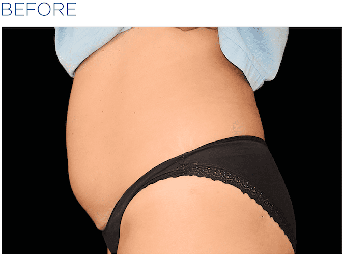 BTL-EMSculpt-Buckinghamshire-S-Thetics-Clinic