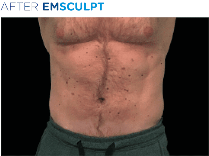 BTL-EMSculpt-available-at-S-Thetics-Skin-Clinic-in-Beaconsfield