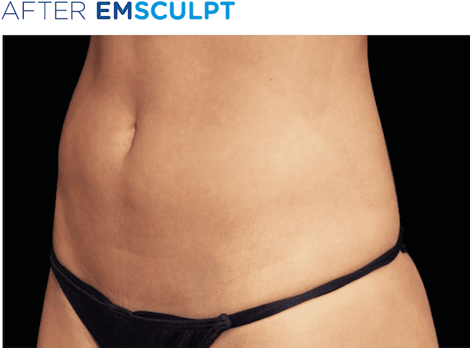 BTL-EMSculpt-available-at-Buckinghamshire-S-Thetics-Aesthetics-Clinic-Beaconsfield