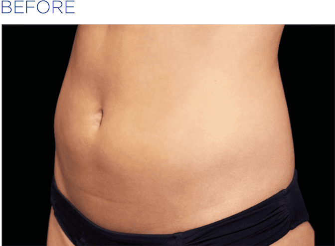 BTL-EMSculpt-available-at-Buckinghamshire-S-Thetics-Aesthetics-Clinic-Beaconsfield