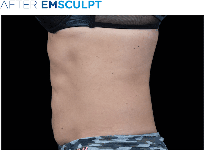 BTL-EMSculpt-available-at-S-Thetics-Clinic-Buckinghamshire-before-and-after