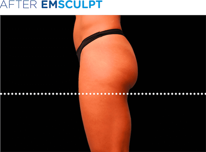 BTL-EMSculpt-non-surgical-booty-lift-available-at-S-Thetics-Aesthetic-Clinic-in-Buckinghamshire
