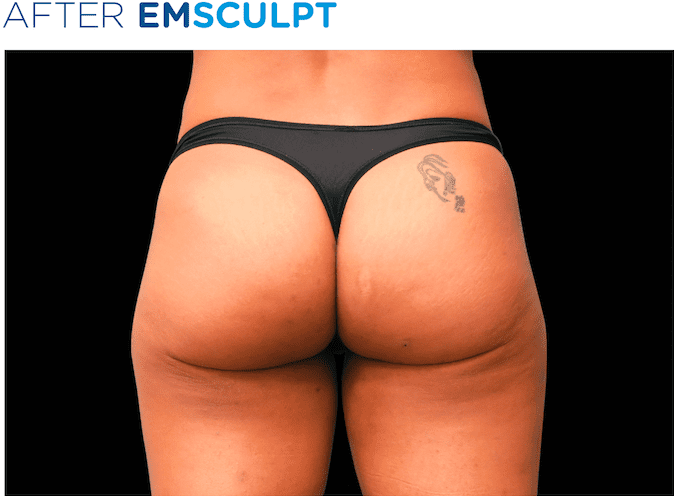 BTL-EMSculpt-non-surgical-buttock-lift-available-at-S-Thetics-Aesthetic-Clinic-in-Beaconsfield-Buckinghamshire
