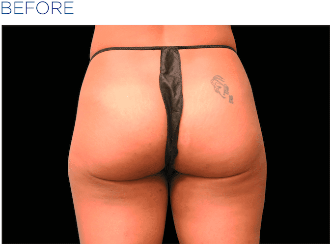 BTL-EMSculpt-non-surgical-buttock-lift-available-at-S-Thetics-Aesthetic-Clinic-in-Buckinghamshire