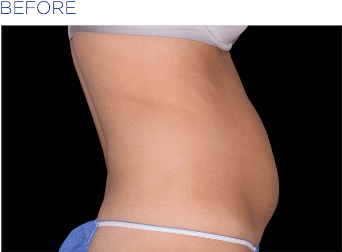 EMSculpt-available-at-S-Thetics-Clinic-Beaconsfield