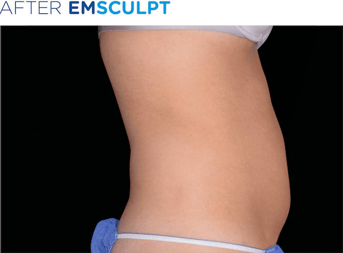 EMSculpt-available-at-S-Thetics-Clinic-in-Buckinghamshire