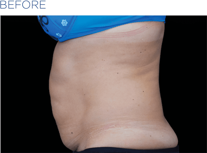 BTL-EMSculpt-available-at-S-Thetics-Clinic-before-and-after