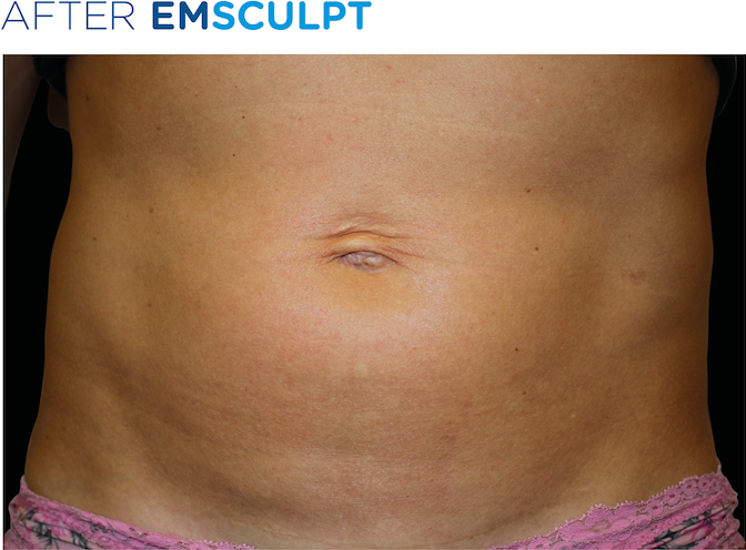 EMSculpt-before-and-after-S-Thetics-Aesthetic-Clinic-Buckinghamshire