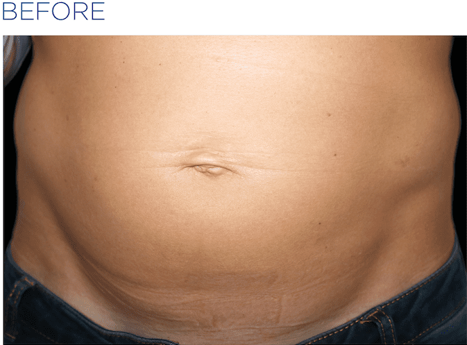 EMSculpt-before-and-after-S-Thetics-Clinic
