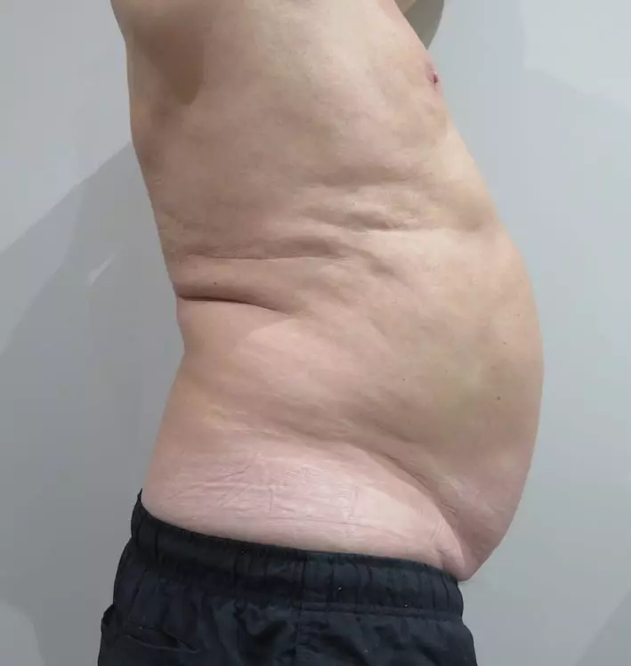 EMSculpt-before-and-after-S-Thetics-Clinic-in-Buckinghamshire