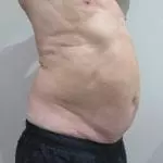 EMSculpt-before-and-after-S-Thetics-Aesthetic-Clinic-in-Buckinghamshire