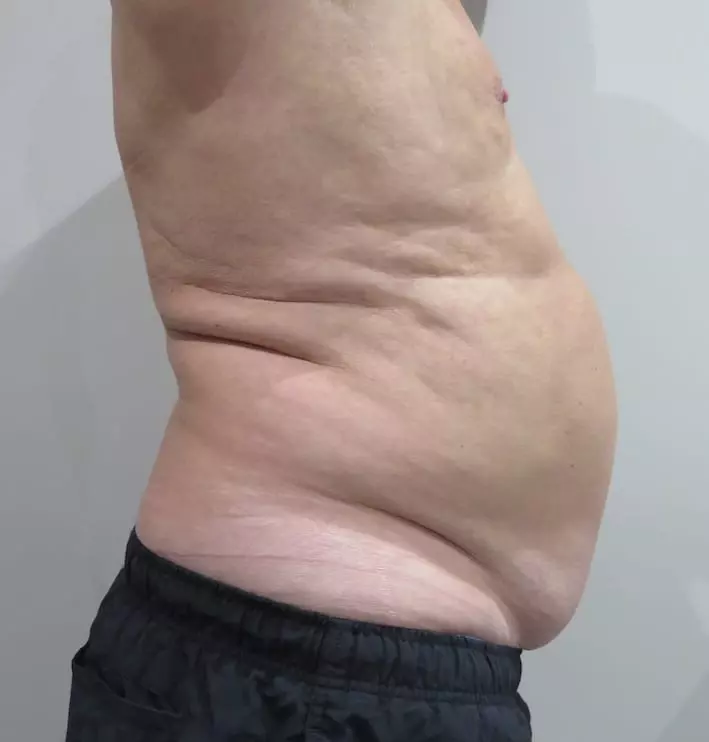 EMSculpt-before-and-after-S-Thetics-Clinic-in-Beaconsfield-Buckinghamshire