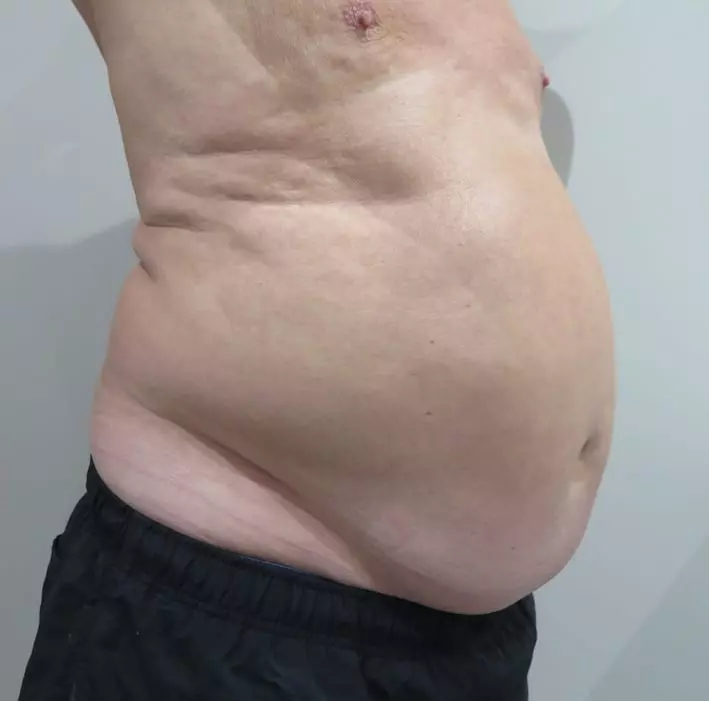 EMSculpt-before-and-after-S-Thetics-Aesthetic-Clinic-in-Beaconsfield-Buckinghamshire