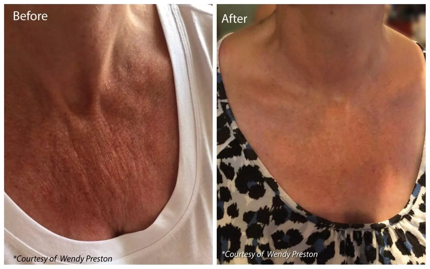 Profhilo-neck-treatment-at-S-Thetics-Skin-Clinic-Buckinghamshire