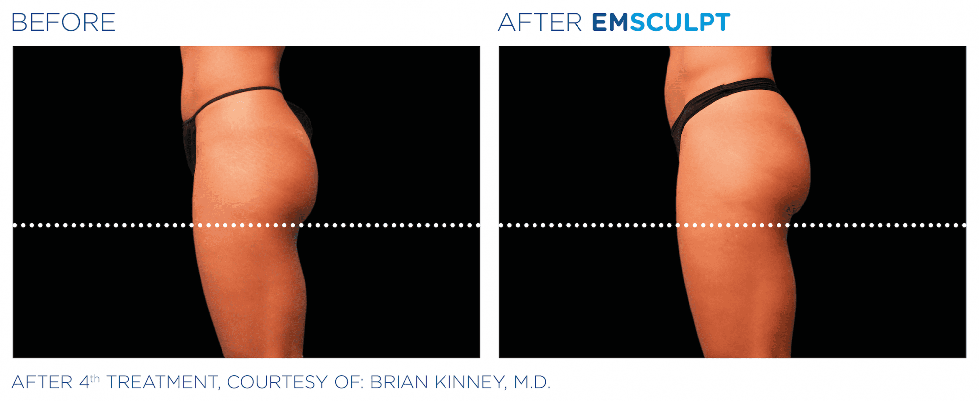 EMSculpt-build-muscle-burn-fat-at-S-Thetics-Aesthetic-Clinic-in-Beaconsfield-Buckinghamshire