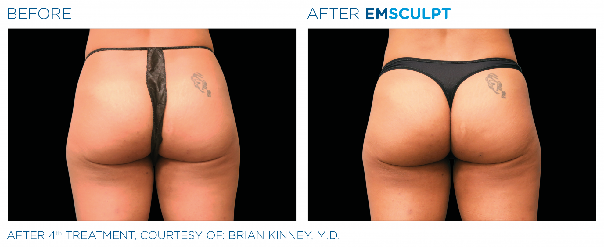 EMSculpt-build-muscle-burn-fat-at-S-Thetics-Aesthetic-Clinic-in-Beaconsfield