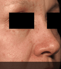 Picosure-laser-skin-rejuvenation-at-S-Thetics-Clinic-After