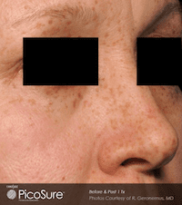 Picosure-laser-skin-rejuvenation-at-S-Thetics-Clinic-Before