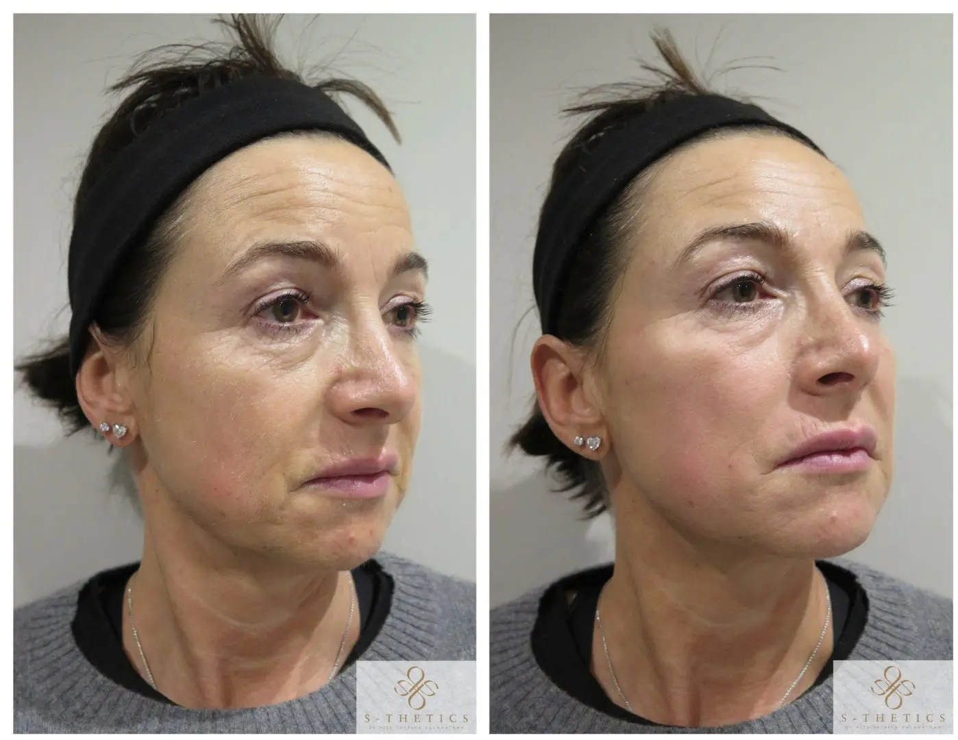 dermal-filler-treatment-at-S-Thetics-Skin-Clinic-in-Beaconsfield-Buckinghamshire-