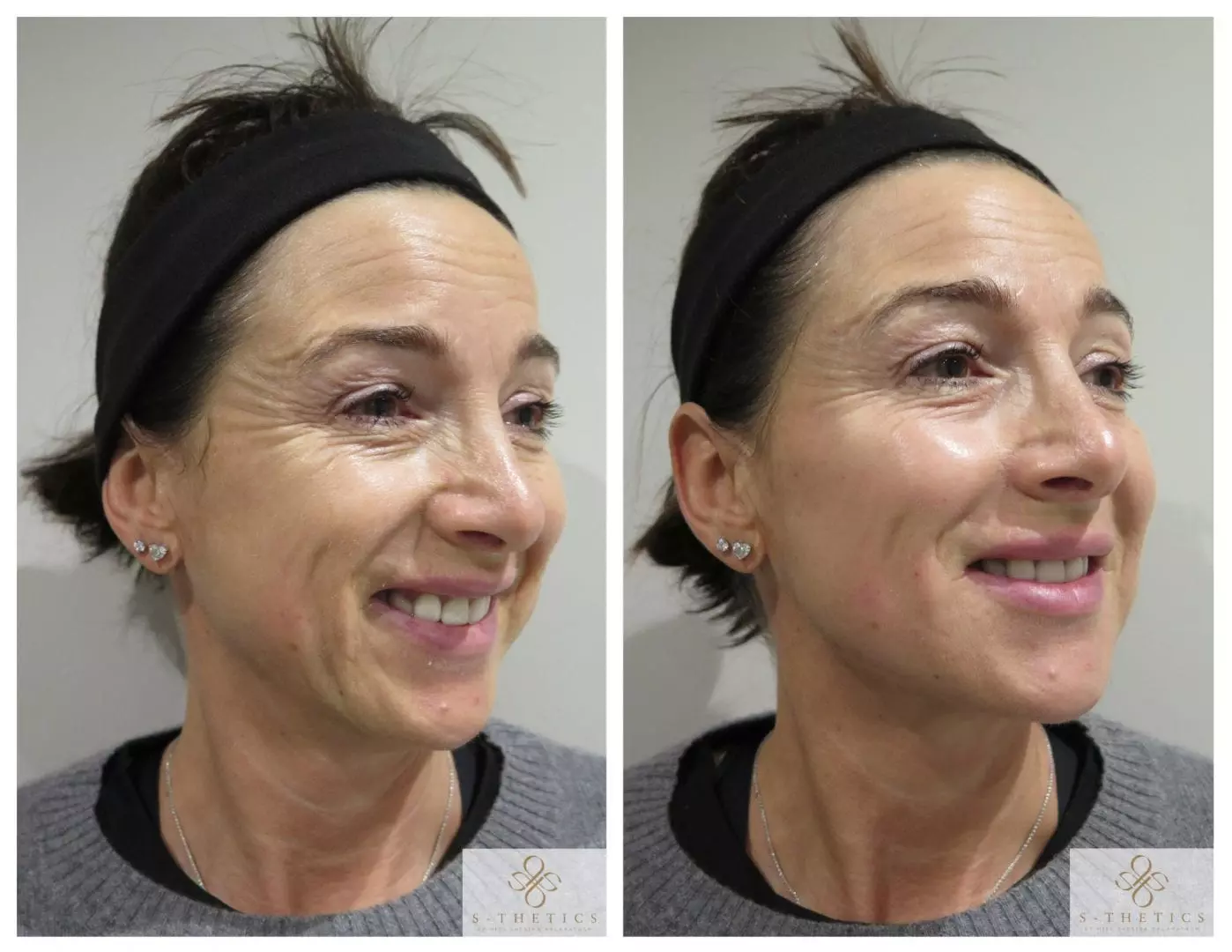 Patient Success Story – Facial Filler Treatment at S-Thetics Clinic
