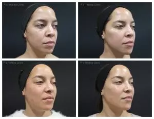 Treating-twins-with-Juvederm-Volux-and-Voluma-at-S-Thetics-Clinic