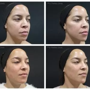 Patient Success Story – treating identical twins with Juvederm Volux & Voluma facial fillers