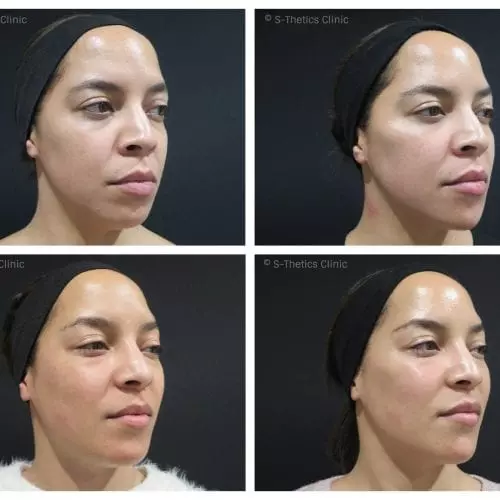 Patient Success Story – treating identical twins with Juvederm Volux & Voluma facial fillers